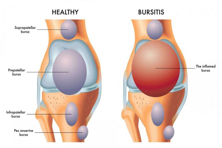 Bursite du genou symptômes causes traitement par les genouillères