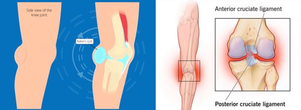 Detrás del dolor de rodilla síntomas causas tratamiento con rodillera