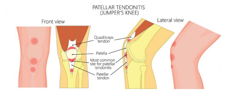 Tendinitis Rotuliana Síntomas Causas Tratamiento Con Rodilleras 4118