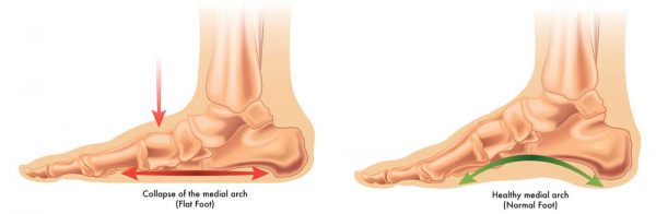 Flat Foot: Symptoms, Causes, Treatment By Foot Braces