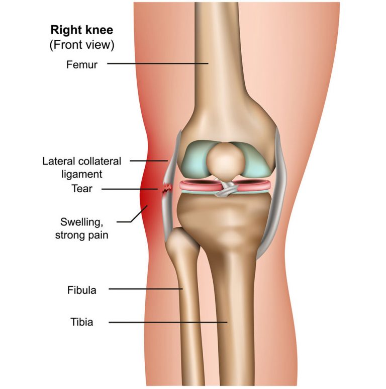 lcl-tear-symptoms-causes-treatment-by-knee-braces