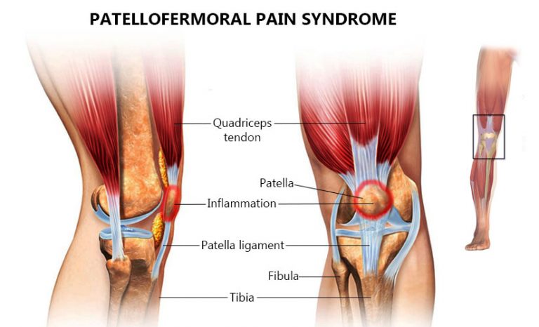 Patellofemoral Pain: Symptoms, Causes, Treatment By Knee Braces