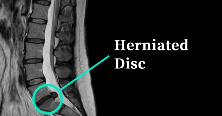 Herniated Disc: Symptoms, Causes, Treatment By Back Braces