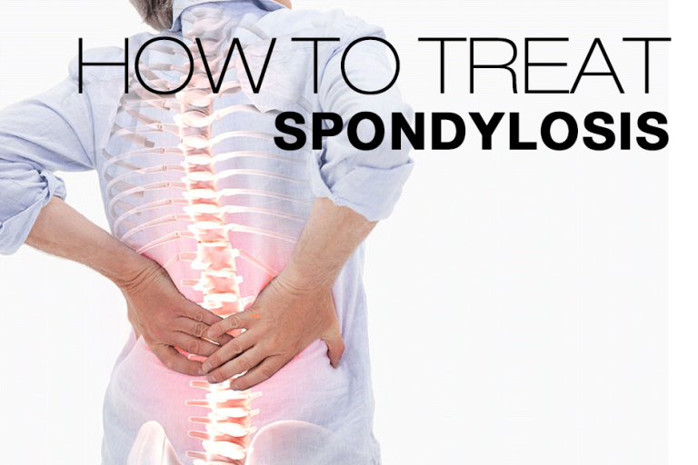 Spondylosis: Symptoms, Causes, Treatment By Back Braces