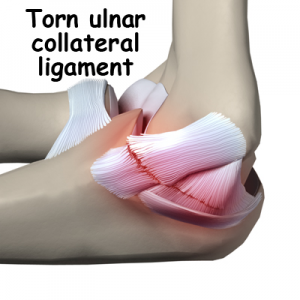 Ulnar Collateral Ligament: Symptoms, Causes, Treatment By Elbow Braces