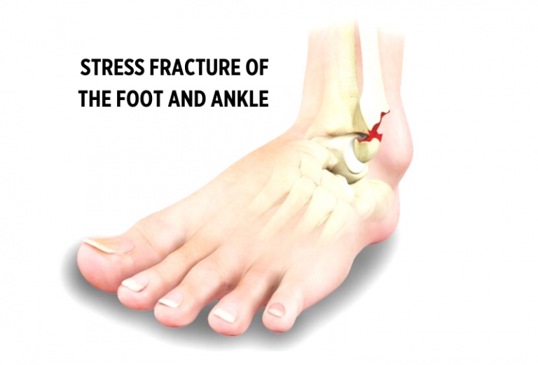 Ankle Stress Fracture: Symptoms, Causes, Treatment By Ankle Braces