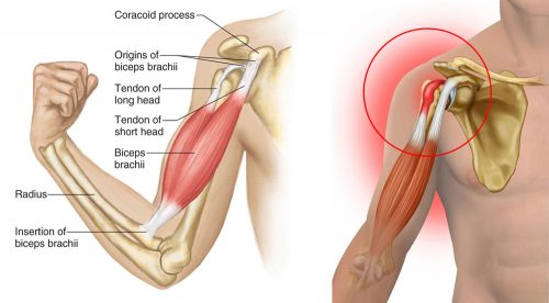 Biceps Tendonitis Symptoms Causes Treatment By Shoulder Braces 6098