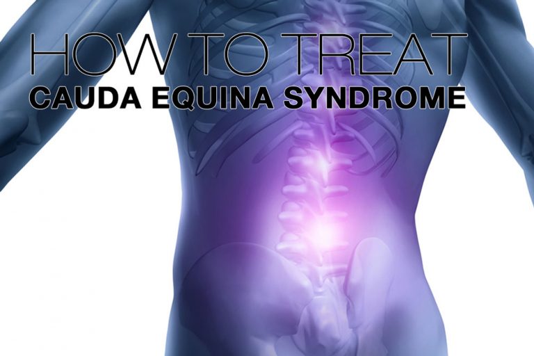 Cauda Equina Syndrome Symptoms Causes Treatment By Back Braces