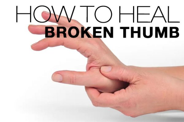 Broken Thumb: Symptoms, Causes, Treatment By Wrist & Thumb Braces