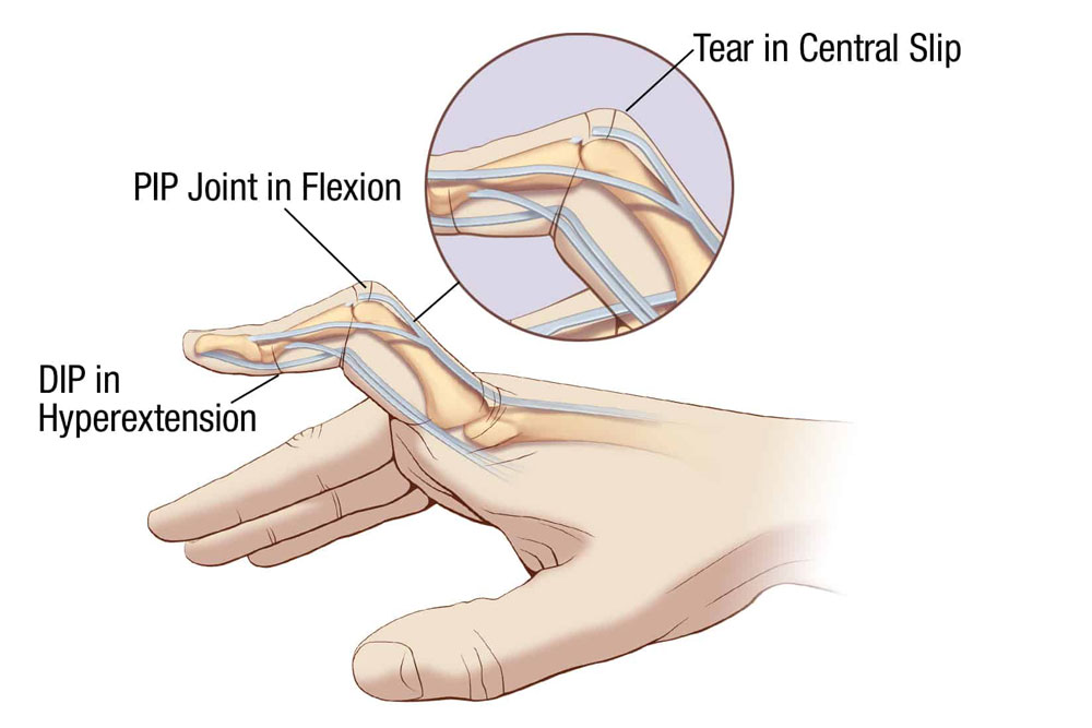 Mallet Finger Symptoms Causes Treatment By Wristt Thumb Braces