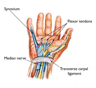 Flexor Tendinitis: Symptoms, Causes, Treatment By Flexor Tendinitis Braces