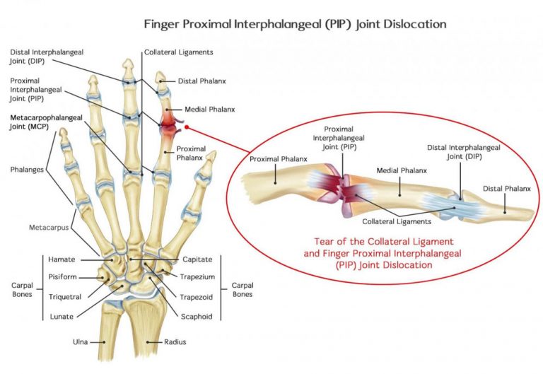 Dislocations Of The PIP Joint: Symptoms, Causes, Treatment By Wrist ...