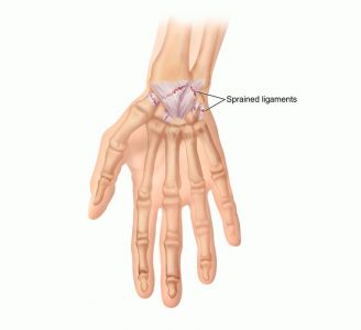 Wrist Sprain: Symptoms, Causes, Treatment By Wrist & Thumb Braces