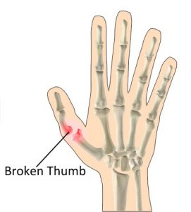 Broken Thumb: Symptoms, Causes, Treatment By Wrist & Thumb Braces