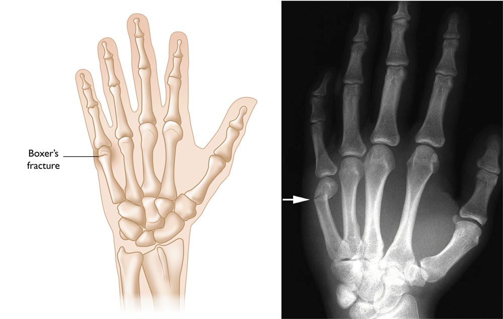 Перелом пальца на руке