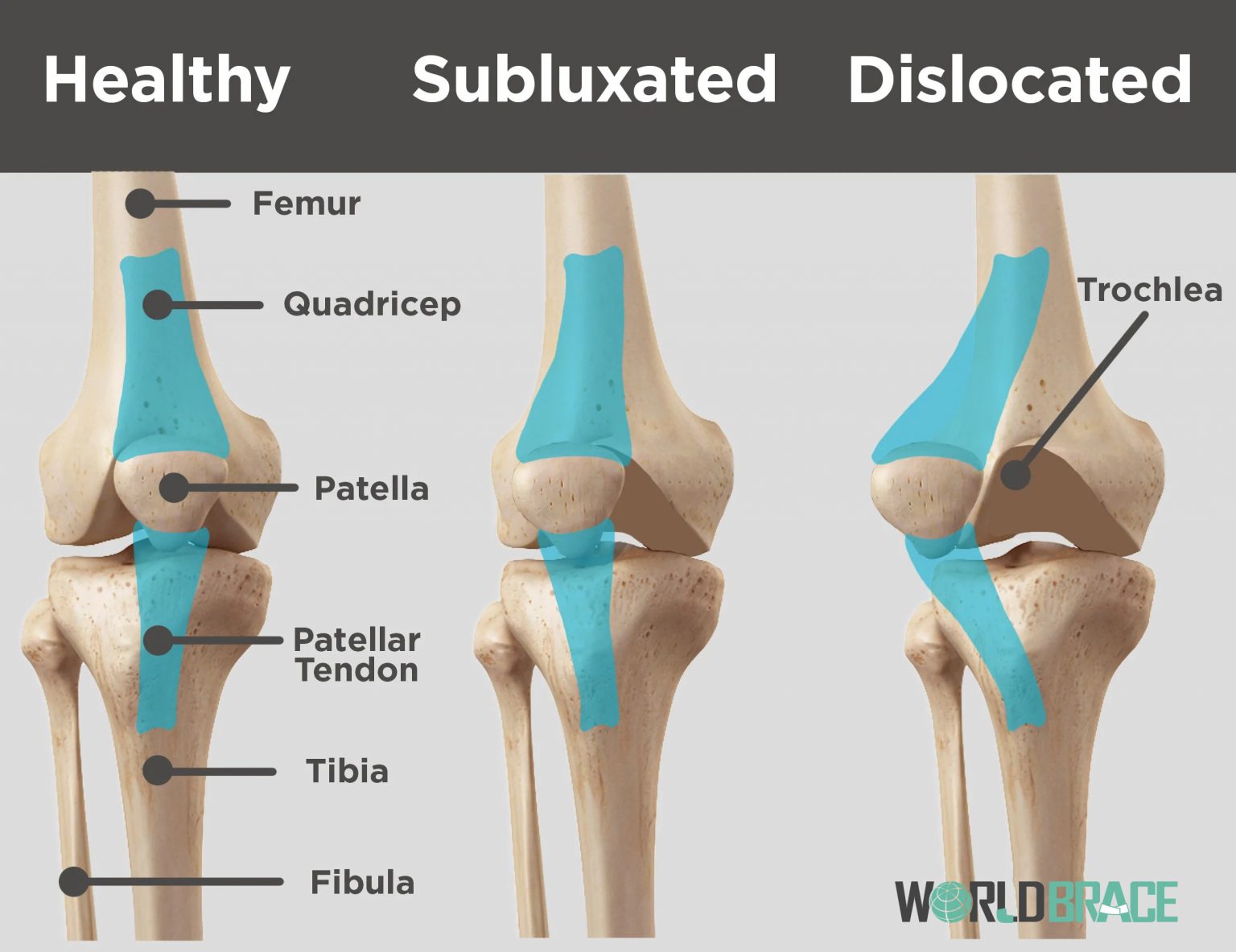 subluxaci-n-patelar-qu-es-la-subluxaci-n-en-la-rodilla-worldbrace