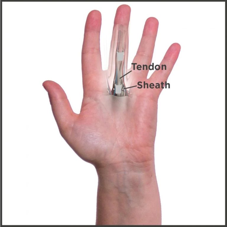 what-exactly-is-trigger-finger-or-stenosing-tenosynovitis-worldbrace